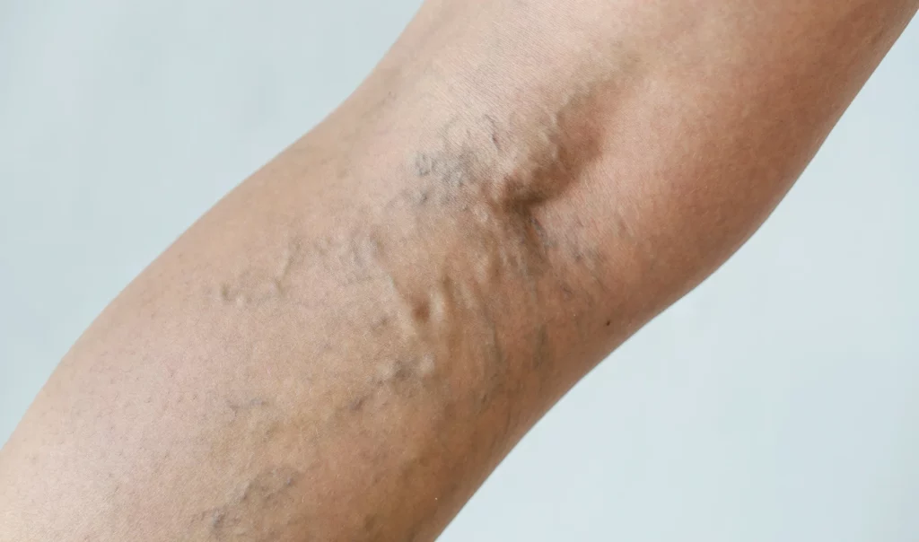 Post-Treatment Care and Recovery